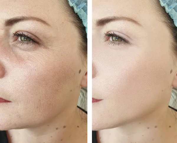 Wanita Menghadapi Keriput Sebelum Dan Setelah Prosedur Kosmetologi — Stok Foto