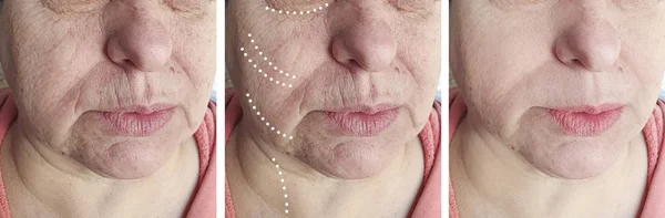 Elderly woman face wrinkles before and after cosmetology procedures