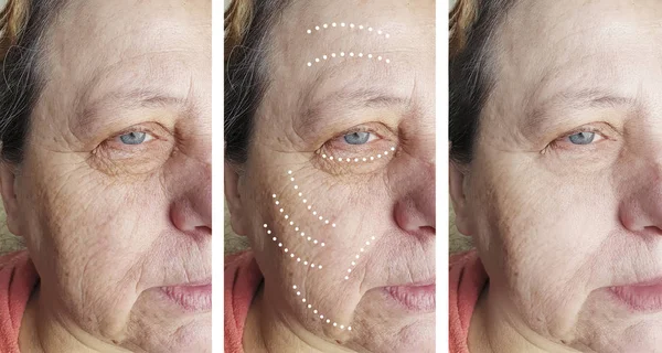 Wanita Tua Menghadapi Kerutan Sebelum Dan Sesudah Prosedur Kosmetologi — Stok Foto