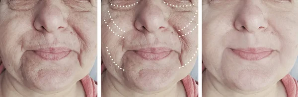 Ηλικιωμένη Γυναίκα Αντιμετωπίζει Ρυτίδες Πριν Και Μετά Από Διαδικασίες Κοσμετολογίας — Φωτογραφία Αρχείου