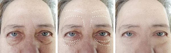 Пожилая Женщина Морщины Лица После Косметологических Процедур — стоковое фото