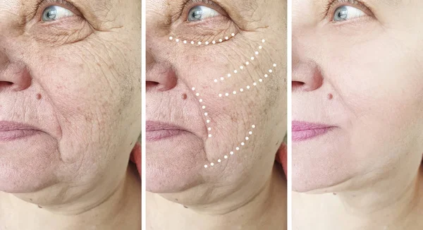 Elderly woman face wrinkles before and after cosmetology procedures