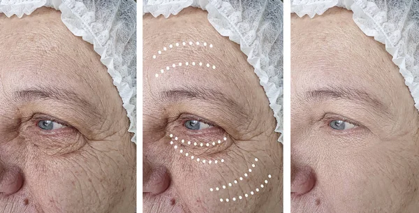 Mujer Anciana Frente Las Arrugas Antes Después Los Procedimientos Cosmetología — Foto de Stock