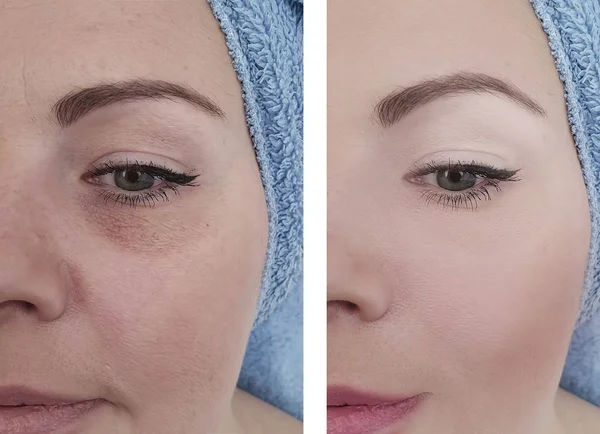 Wanita Wajah Keriput Sebelum Dan Setelah Perawatan — Stok Foto
