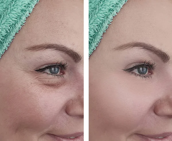 Woman Face Wrinkles Treatments — Stock Photo, Image