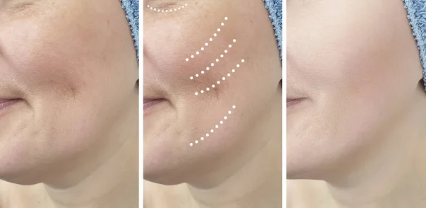 Arrugas Mujer Antes Después Del Tratamiento —  Fotos de Stock