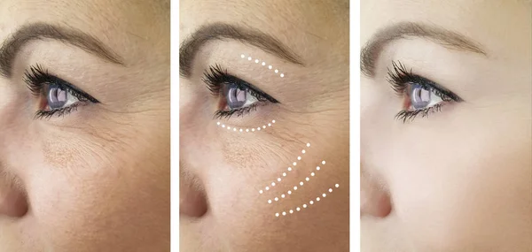 Arrugas Mujer Antes Después Del Tratamiento —  Fotos de Stock