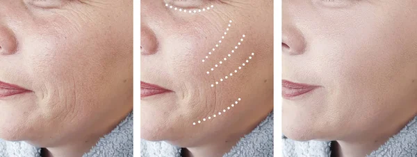 Woman Wrinkles Regeneration Collage Procedures — Stock Photo, Image