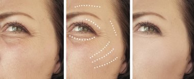 Yenilenme kolajı öncesi ve sonrası kırışıklıklar