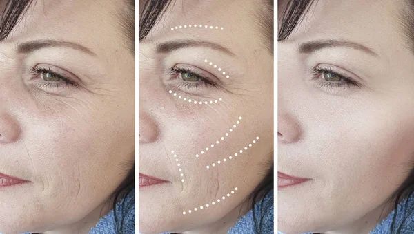 Arrugas Mujer Antes Después Procedimientos Collage Regeneración —  Fotos de Stock