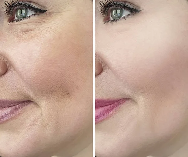 Wanita Keriput Sebelum Dan Setelah Prosedur Kosmetologi — Stok Foto