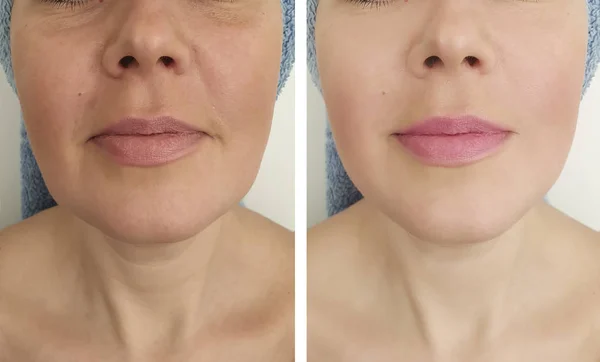 Falten Bei Frauen Vor Und Nach Kosmetologischen Eingriffen — Stockfoto