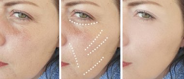 kadın önce ve sonra kozmetoloji prosedürleri kırışıklıkları