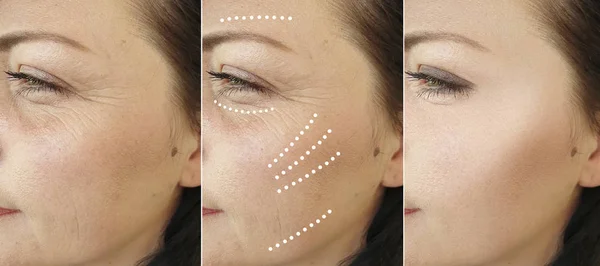 Arrugas Mujer Antes Después Procedimientos Cosmetología — Foto de Stock