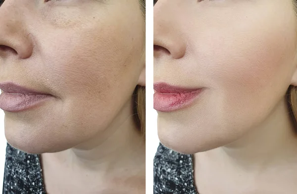 woman face wrinkles before and after cosmetology treatment