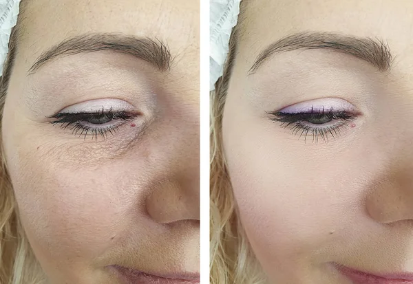 woman face wrinkles before and after cosmetology treatment