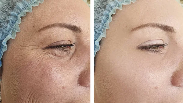 Arrugas Cara Mujer Antes Después Del Tratamiento Cosmetológico — Foto de Stock