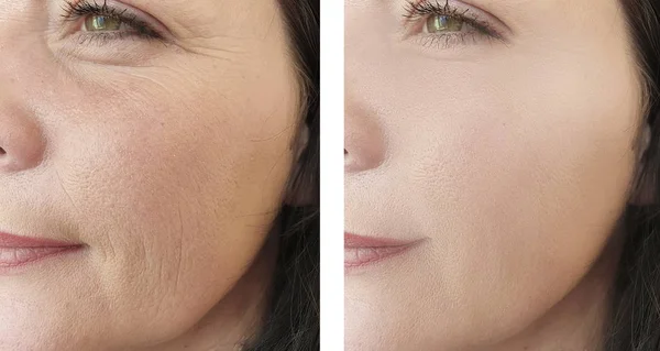 Falten Gesicht Der Frau Vor Und Nach Der Kosmetologischen Behandlung — Stockfoto