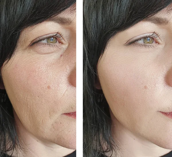 Wanita Menghadapi Keriput Sebelum Dan Setelah Perawatan Kosmetologi — Stok Foto