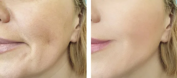 Woman Face Wrinkles Correction Procedures — 스톡 사진