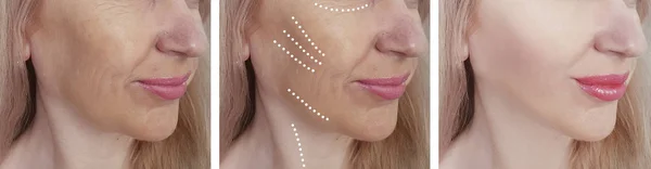 Arrugas Cara Mujer Antes Después Los Procedimientos Corrección —  Fotos de Stock