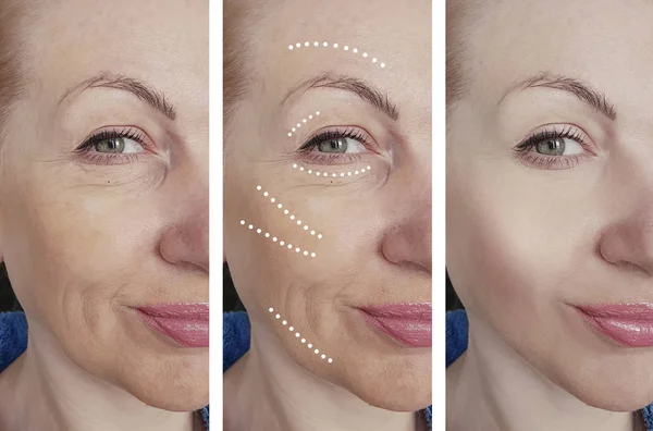 Arrugas Cara Mujer Antes Después Los Procedimientos Corrección — Foto de Stock