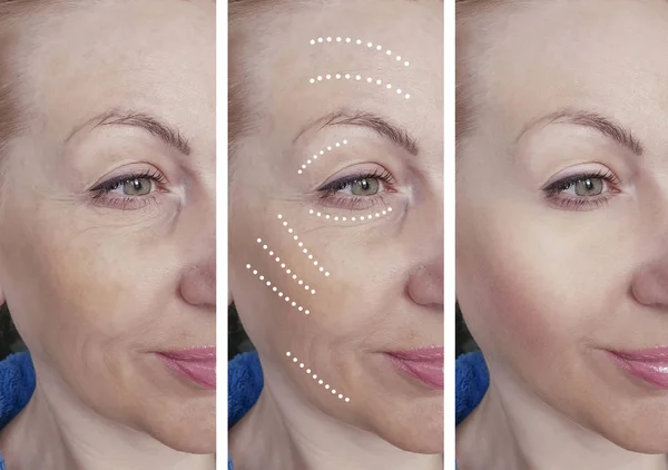 woman face wrinkles before and after correction procedures