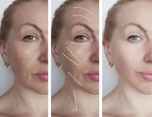 Arrugas Cara Mujer Antes Después Los Procedimientos Corrección — Foto de Stock
