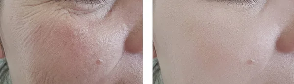 woman face wrinkles before and after correction procedures
