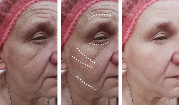 Las Arrugas Mujer Anciana Enfrentan Antes Después Los Procedimientos Corrección — Foto de Stock