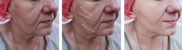 Wanita Tua Keriput Wajah Sebelum Dan Setelah Prosedur Koreksi — Stok Foto
