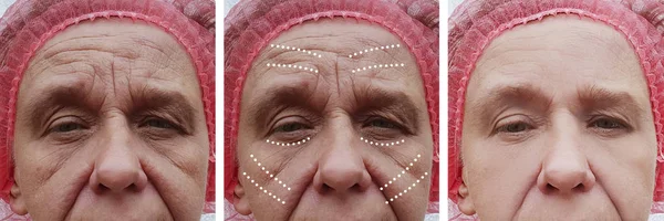 矯正手順の前後に高齢女性のしわが顔 — ストック写真