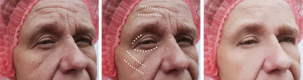 Elderly woman\'s wrinkles face before and after correction procedures