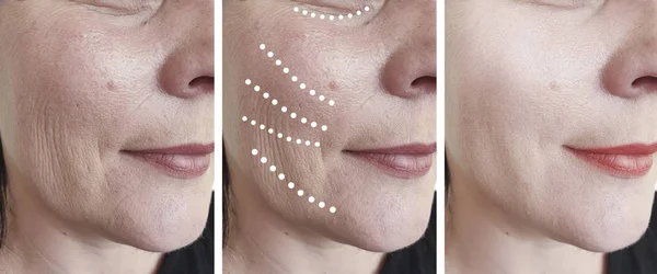Wanita Wajah Keriput Sebelum Dan Setelah Koreksi Kolase — Stok Foto
