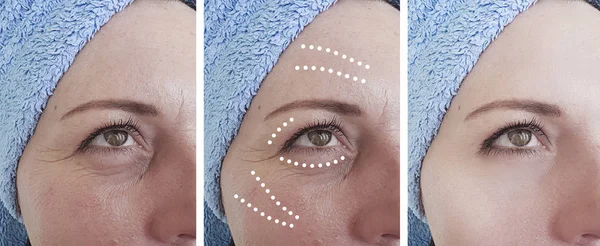 Arrugas Cara Mujer Antes Después Collage Corrección —  Fotos de Stock