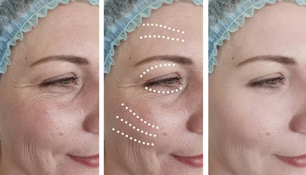 Woman Face Wrinkles Correction Collage — Stock Photo, Image