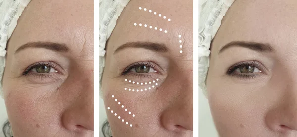 Arrugas Cara Mujer Antes Después Collage Corrección — Foto de Stock