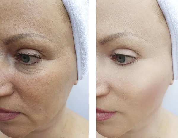 Woman Wrinkles Lifting Procedures Correction — 스톡 사진