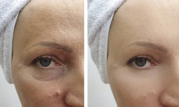 Arrugas Mujer Antes Después Los Procedimientos Elevación Corrección —  Fotos de Stock