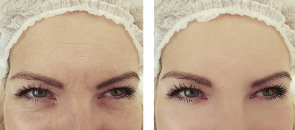 Arrugas Mujer Antes Después Los Procedimientos Eliminación — Foto de Stock