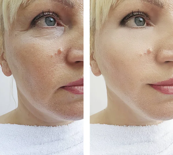 Arrugas Mujer Cara Antes Después Los Procedimientos Corrección —  Fotos de Stock