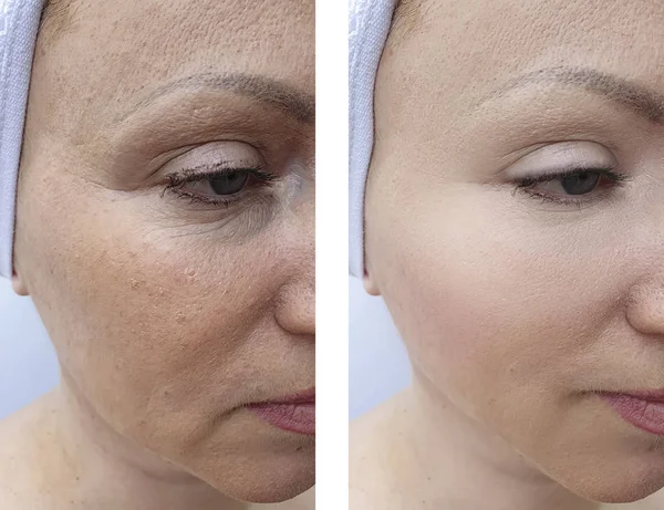 woman wrinkles face before and after correction procedures