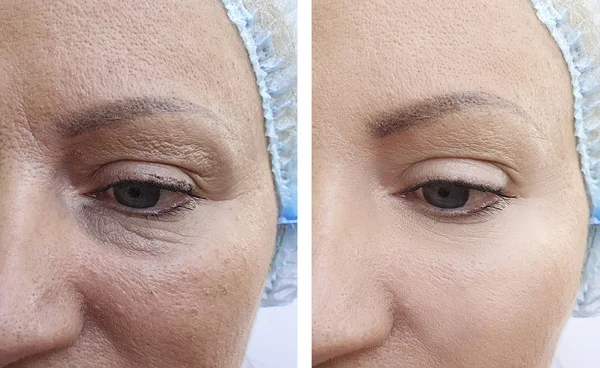 woman wrinkles face before and after correction procedures