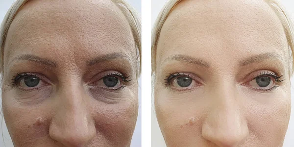 Arrugas Mujer Cara Antes Después Los Procedimientos Corrección — Foto de Stock
