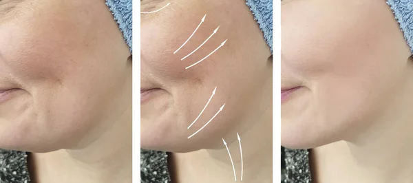 woman wrinkles face before and after correction procedures