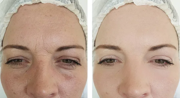 Kadın Göz Kırışıklıkları Öncesi Sonrası Düzeltme Işlemleri — Stok fotoğraf