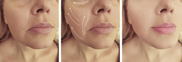Female Wrinkles Correction Procedures — Stock Photo, Image