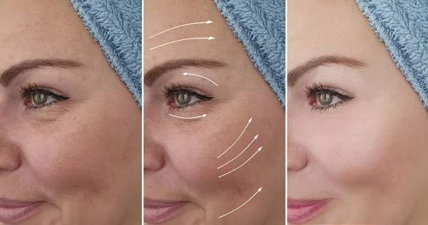 female wrinkles before and after correction procedures