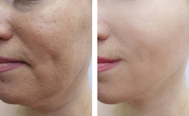 kadın düzeltme öncesi ve sonrası yüz kırışıklıkları
