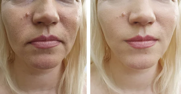 Wanita Keriput Wajah Sebelum Dan Setelah Koreksi — Stok Foto